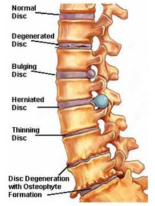 Degenerative Disc Disease