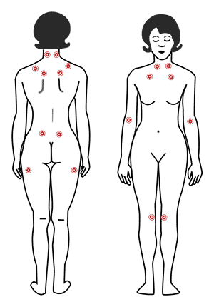 Fibromyalgia