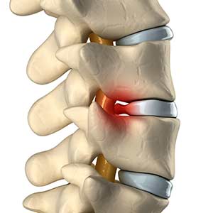 Herniated, Bulging Discs
