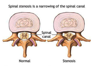 Spinal Stenosis